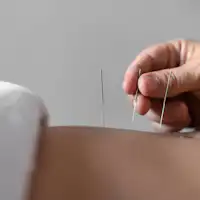 ภาพการฝังเข็มและการบำบัดร่างกาย